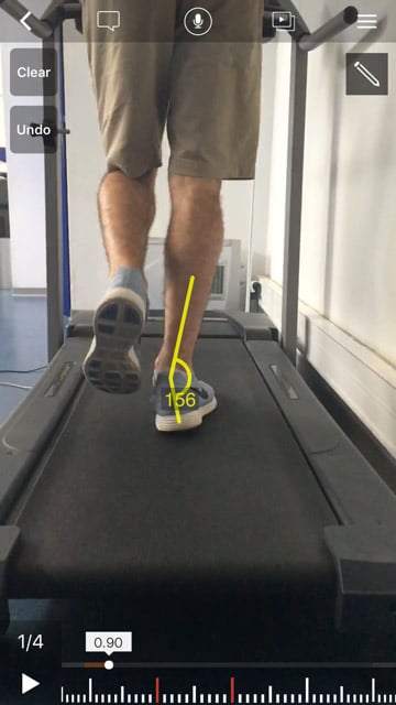 Hyper-Pronation-D